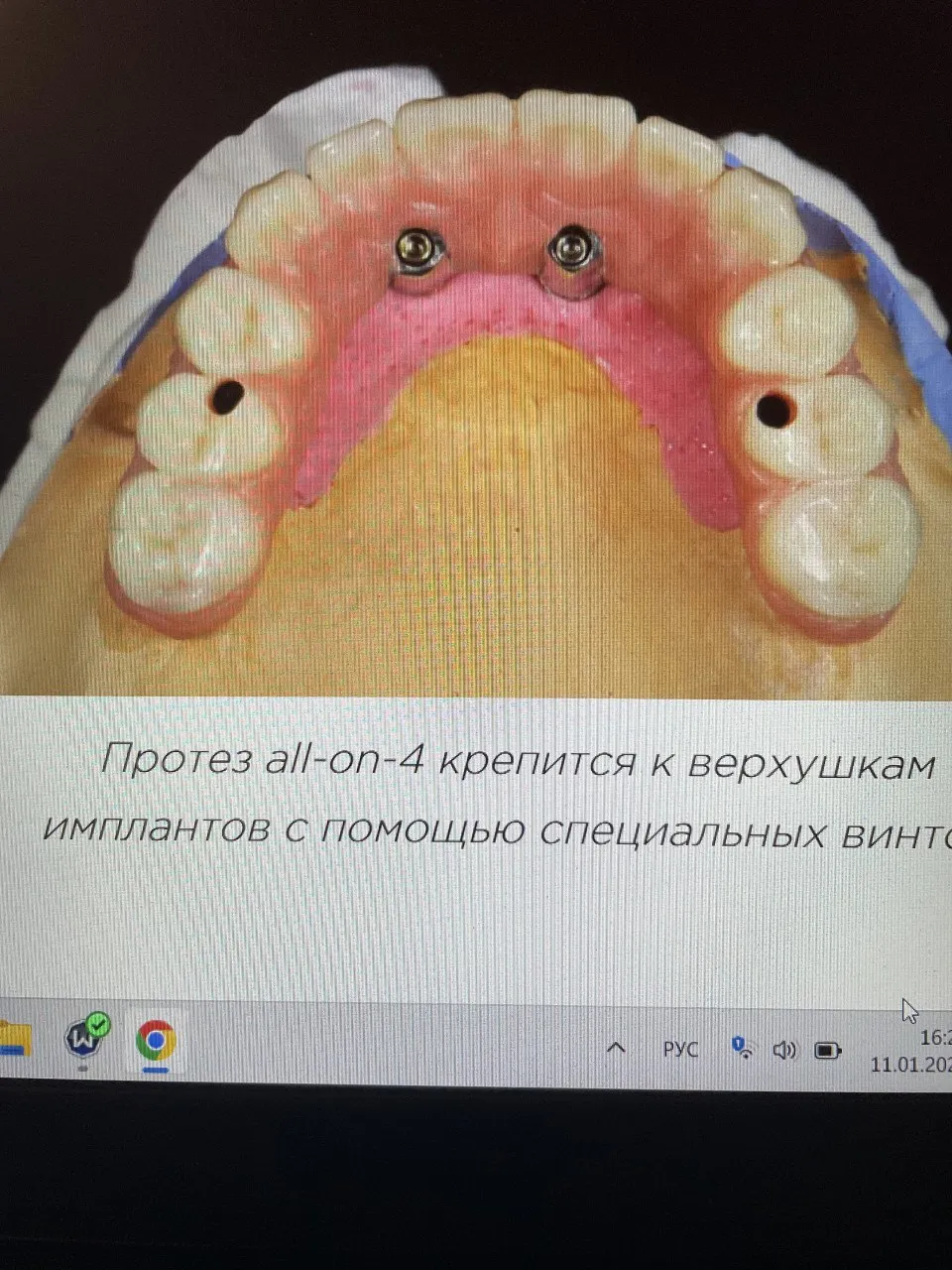 Протез на моделі — вигляд зверху